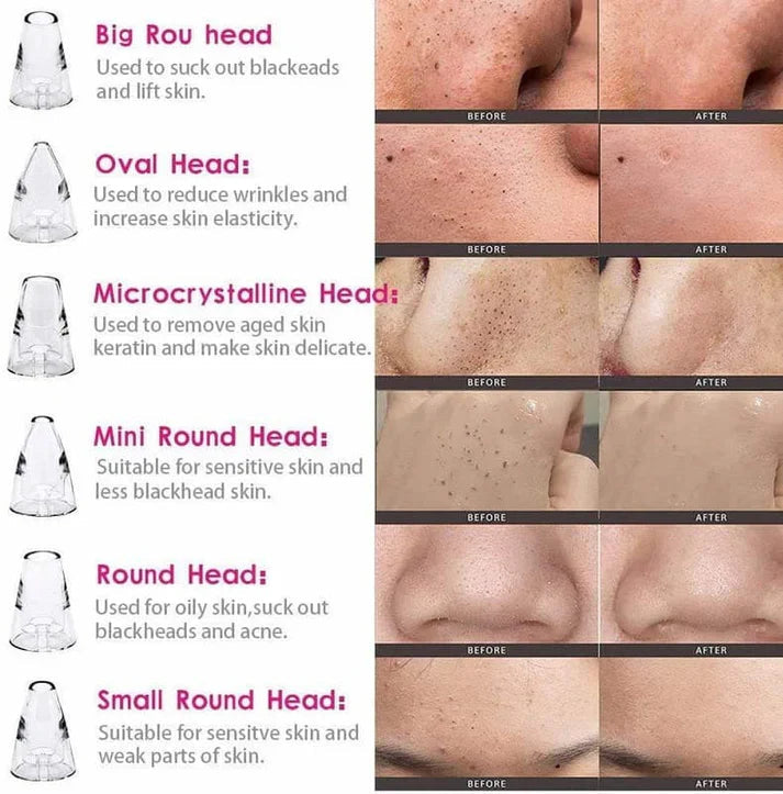 Acne Pore Cleaner & Black Head Remover